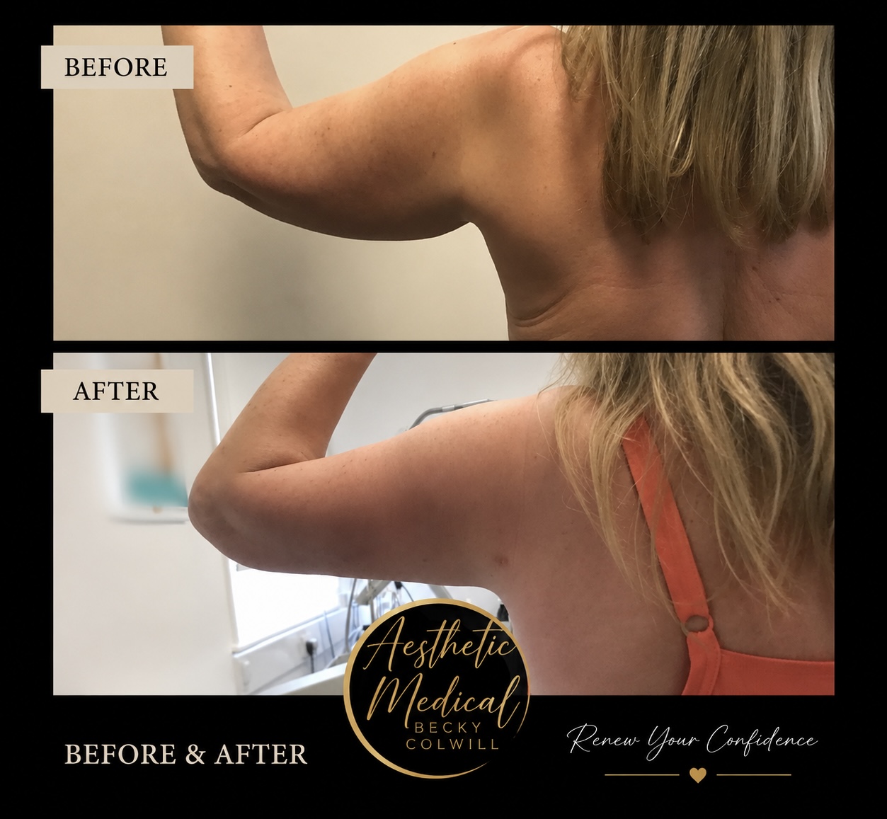 Endolift arms before and after — Patient 1, real Aesthetic Medical Ltd patient