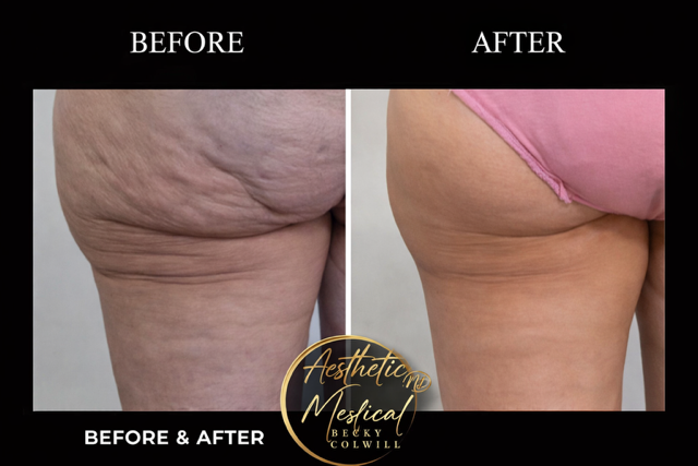 Endolift buttocks before and after — real Aesthetic Medical Ltd patient with visible cellulite reduction and skin tightening