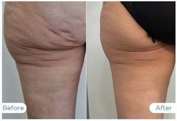Endolift thigh cellulite reduction before and after