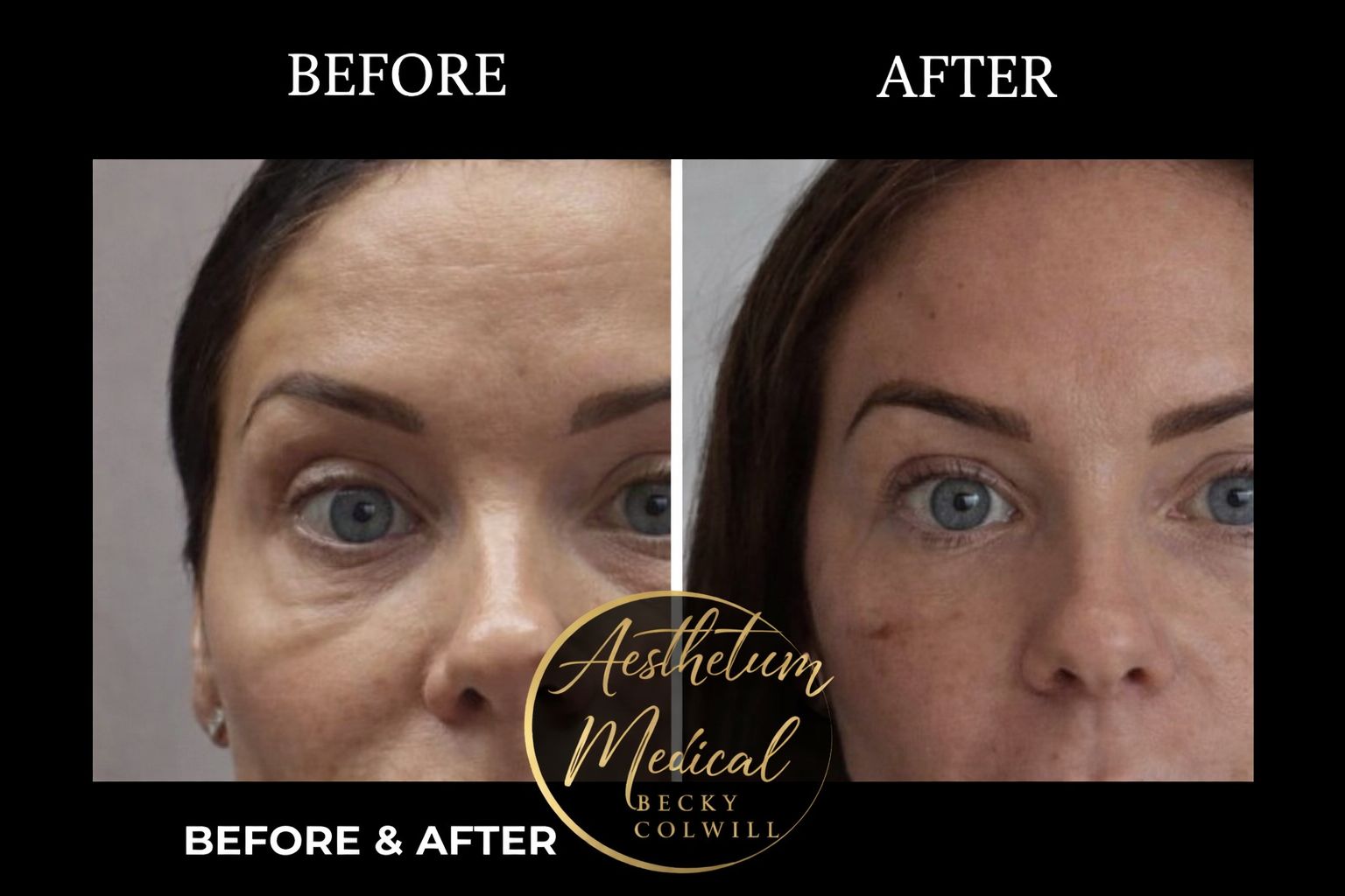 Eye Area Rejuvenation