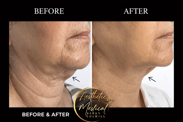 Jowls & Neck — Mature Skin