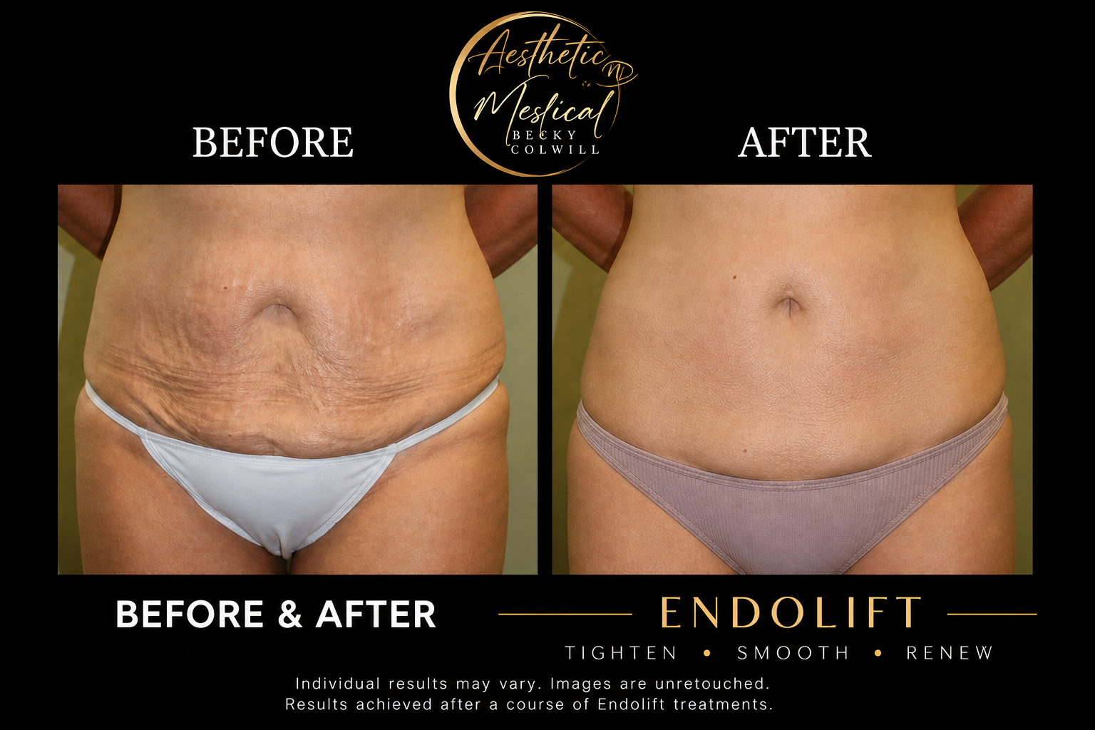 Endolift stomach before and after — real Aesthetic Medical Ltd patient with visible skin tightening and fat reduction
